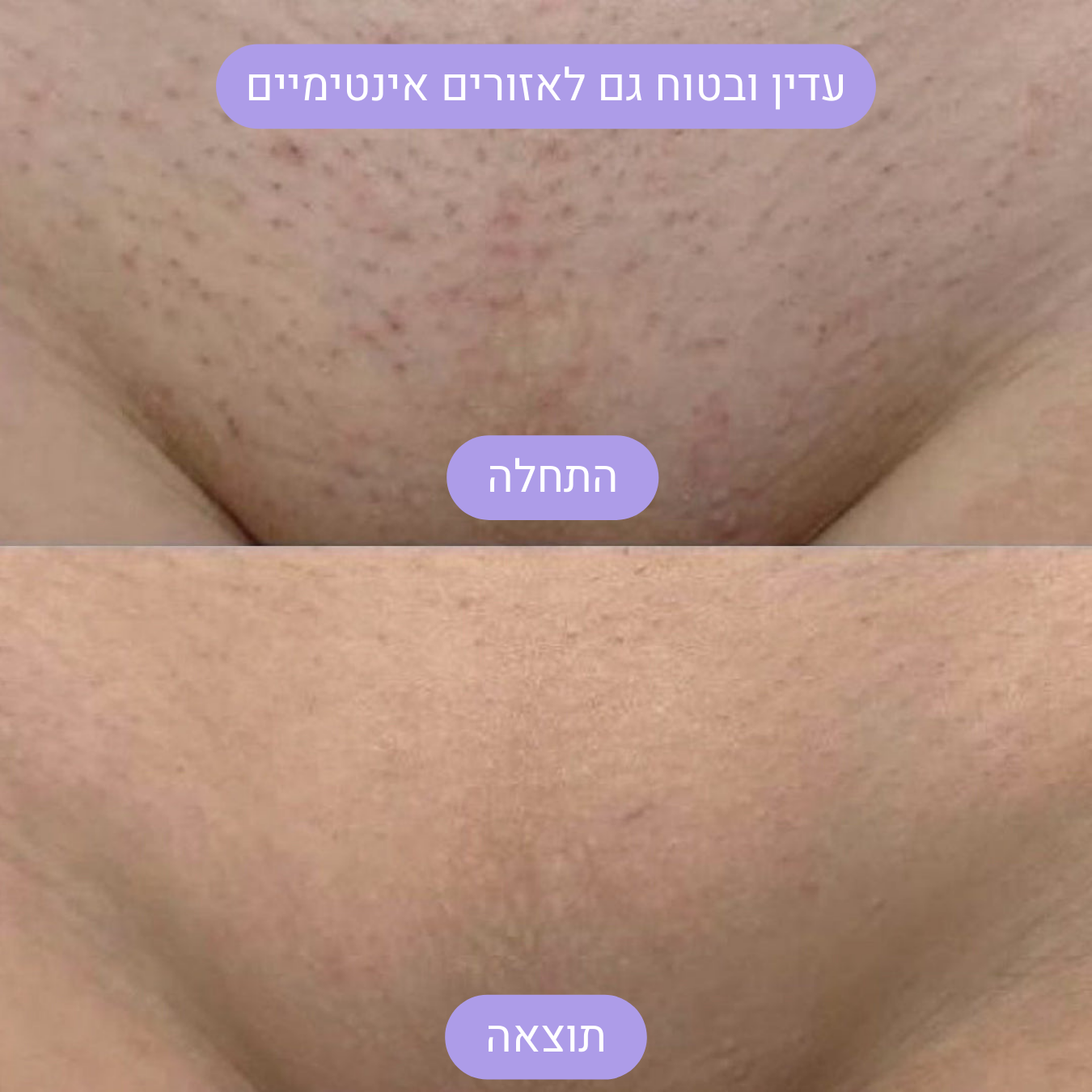 מכשיר ההסרת שיער בלייזר של Nura