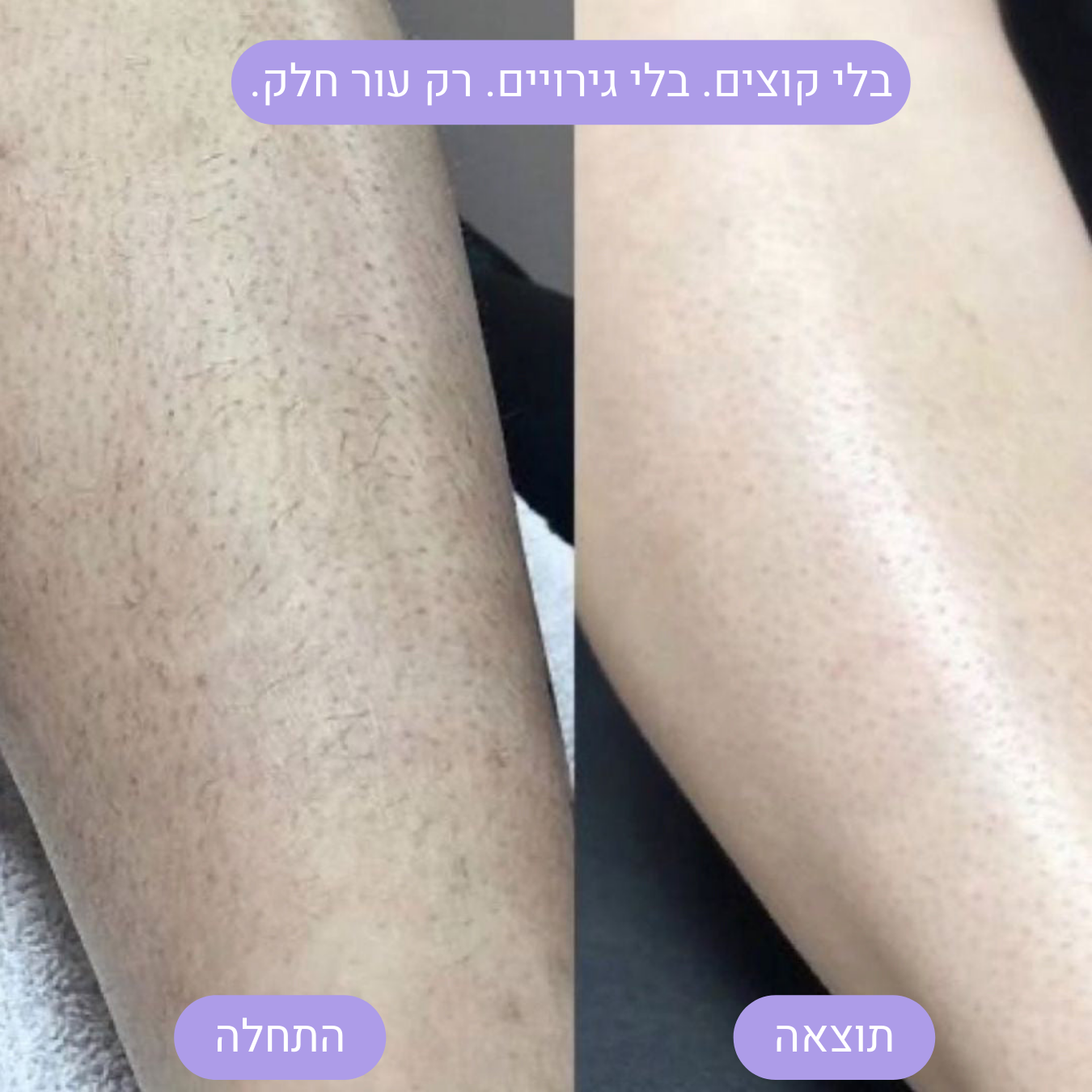 מכשיר ההסרת שיער בלייזר של Nura